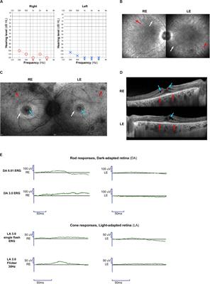 A 4.6 Mb Inversion Leading to PCDH15-LINC00844 and BICC1-PCDH15 Fusion Transcripts as a New Pathogenic Mechanism Implicated in Usher Syndrome Type 1